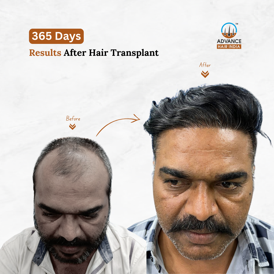 Hair Transplant Result